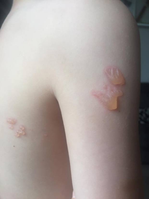 A five-year-old Mornington boy woke up with 16 blisters on his body. Photo / Supplied