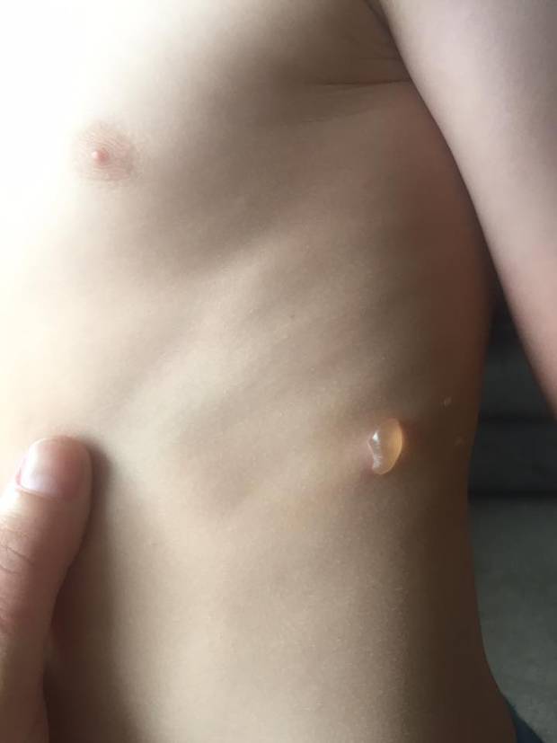 Jenna Limmer said the doctor couldn't say where her son's blisters came from, but hadn't heard of the beetle. Photo / Supplied
