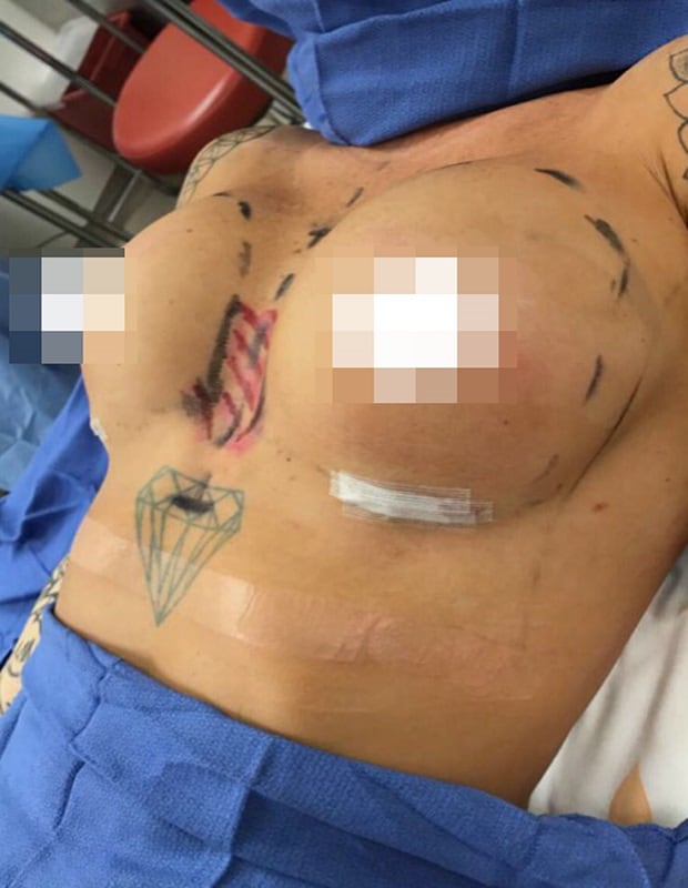 Amanda had a second boob job earlier this year to correct the mistakes of her first surgery (pictured after the second breast augmentation). Photo / Caters News Agency