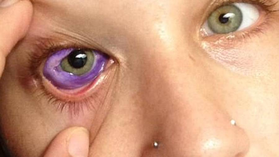 A model tattooed her eyeball purple. She now could lose her eye.