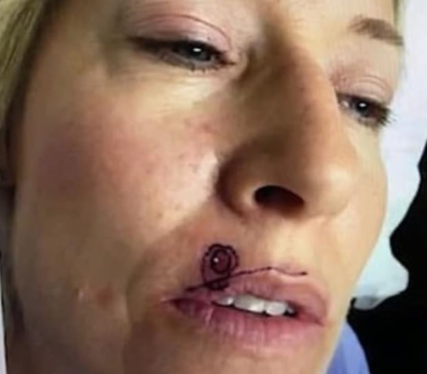 When A Woman S Tiny Pimple Turned Into A Scab She Knew Something