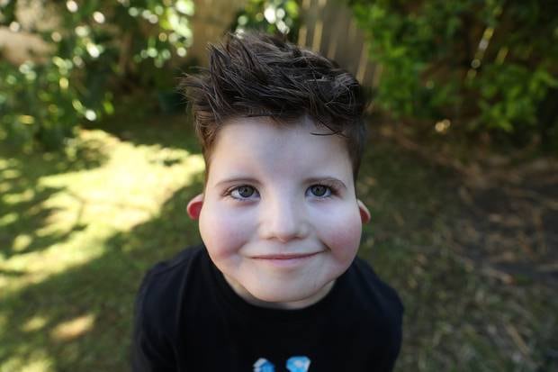 After two 8-hour-long surgeries over the last year Auckland boy Charlie Kiefte is smiling for the first time. Photo / Doug Sherring
