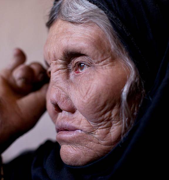 Why leprosy has not yet been eradicated - NZ Herald