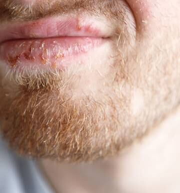 I Gave My Father Herpes Reddit Post Reveals Shared Razor Almost Ruined Marriage Nz Herald