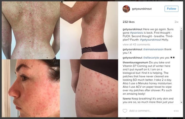 World Psoriasis Day My Psoriasis Story Nz Herald