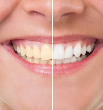Five Experts Explain Is Whitening Bad For Your Teeth Nz Herald
