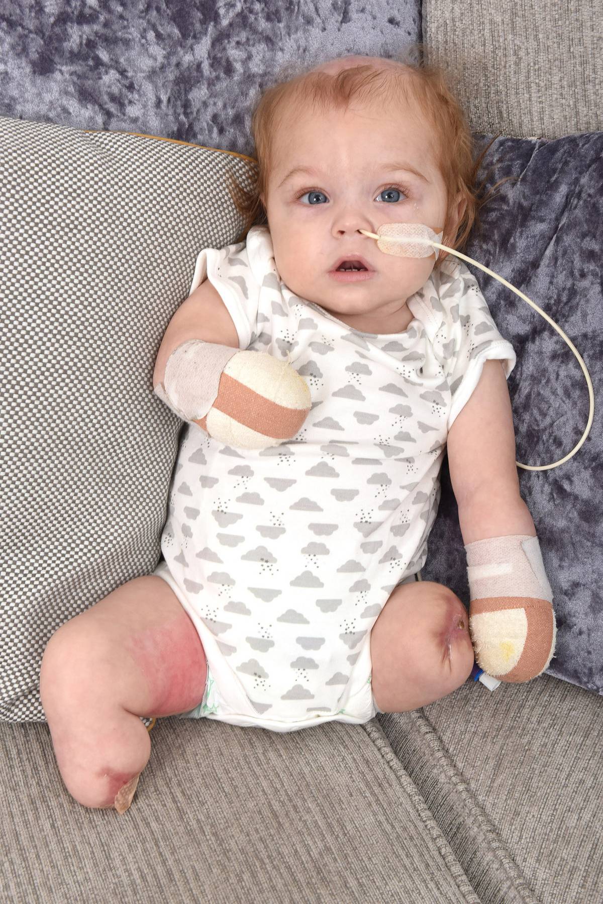 Sepsis Nightmare Uk Mother Reveals Babys Leg Detached In Her Hand