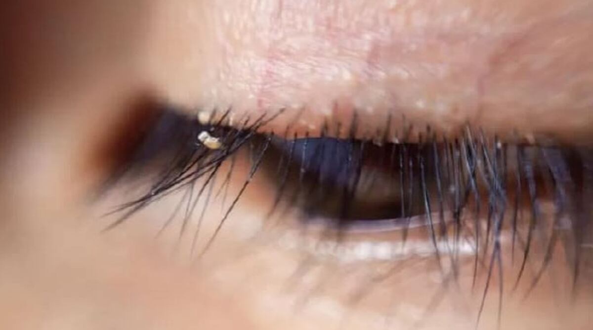 Warning As Eyelash Extensions Could Be Crawling With Eyelash Lice