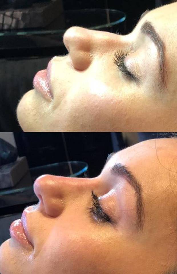 Here S What You Need To Know About The Liquid Nose Job Nz Herald