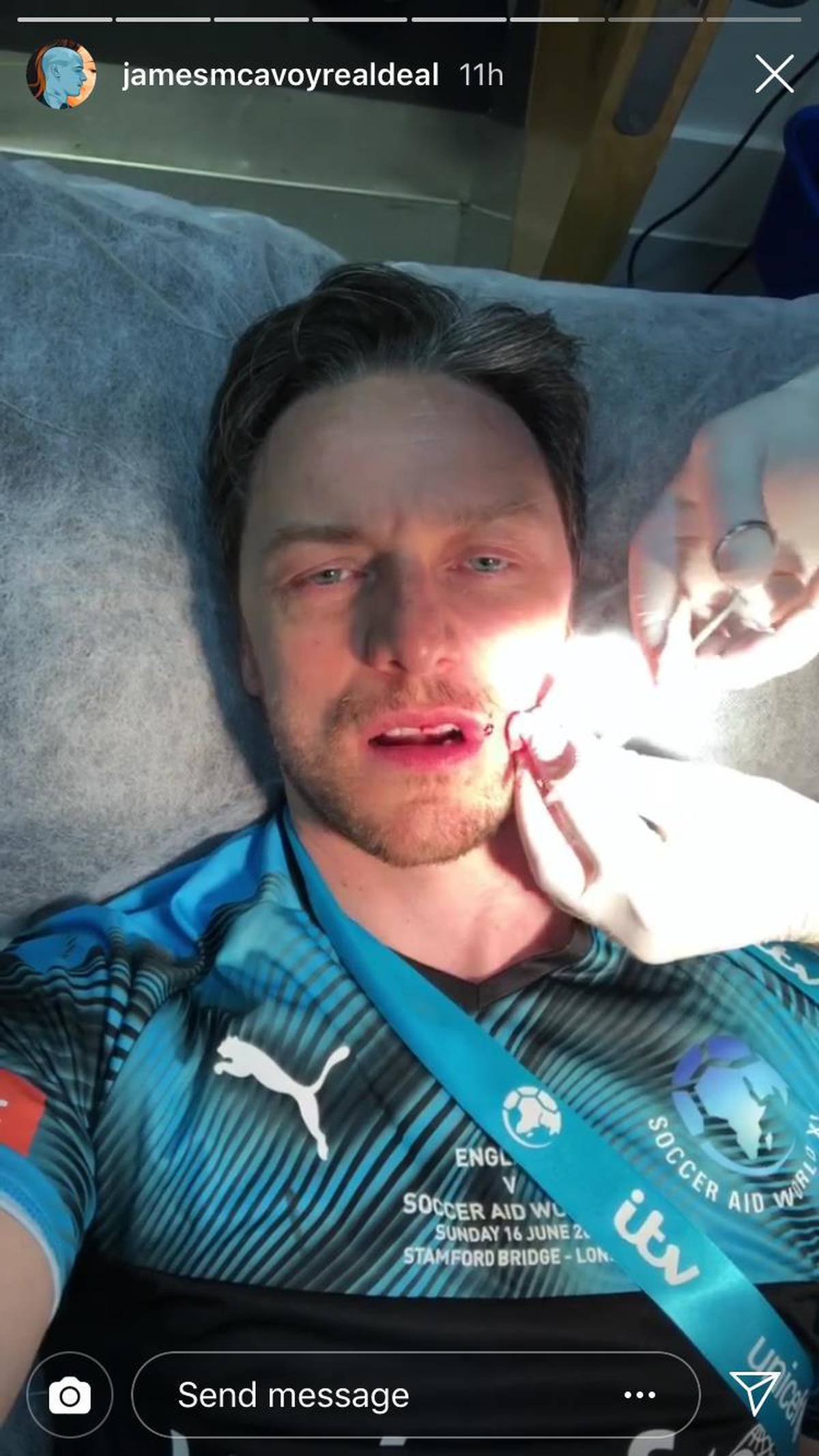 James Mcavoy Shares Gruesome Video As He Gets Stitches After His