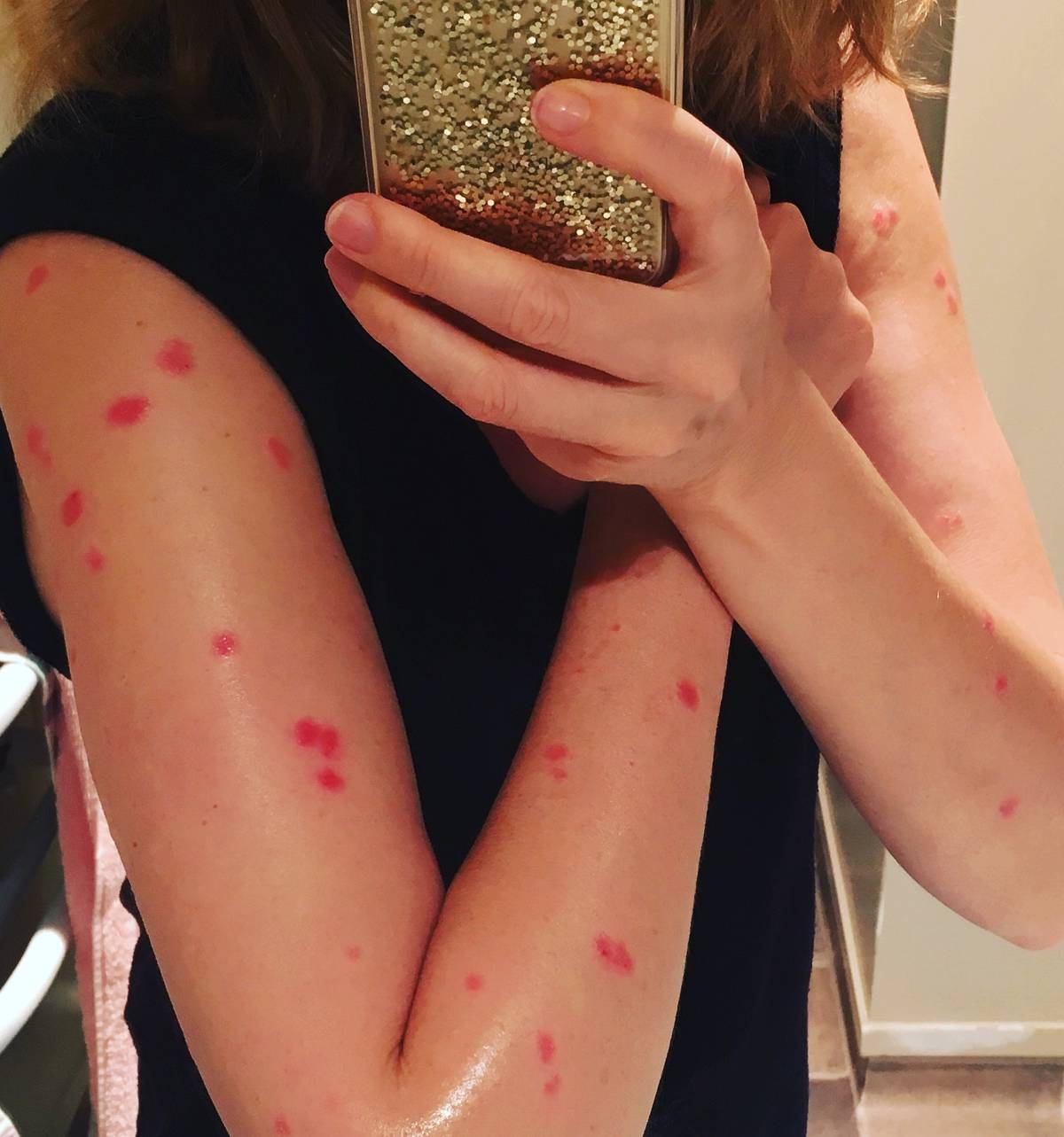 World Psoriasis Day My Psoriasis Story Nz Herald