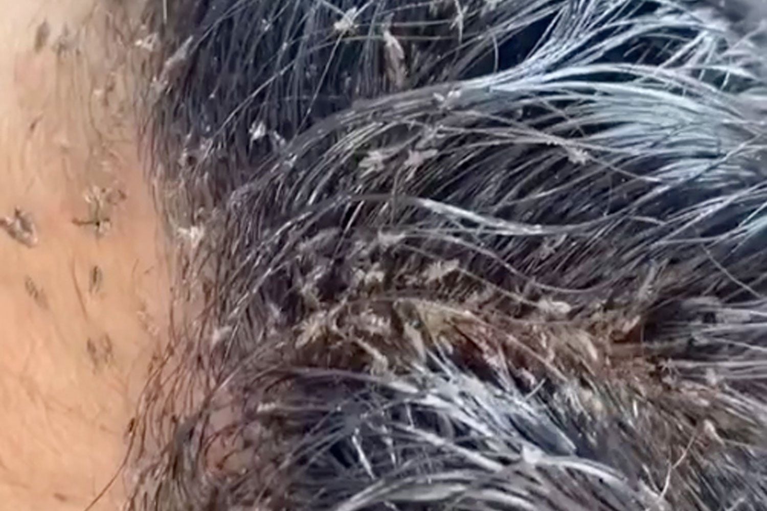 Watch: Shocking video shows young girl's 'Level 10' lice infestation - NZ Herald Watch: Shocking video shows young girl's 'Level 10' lice infestation - NZ Herald