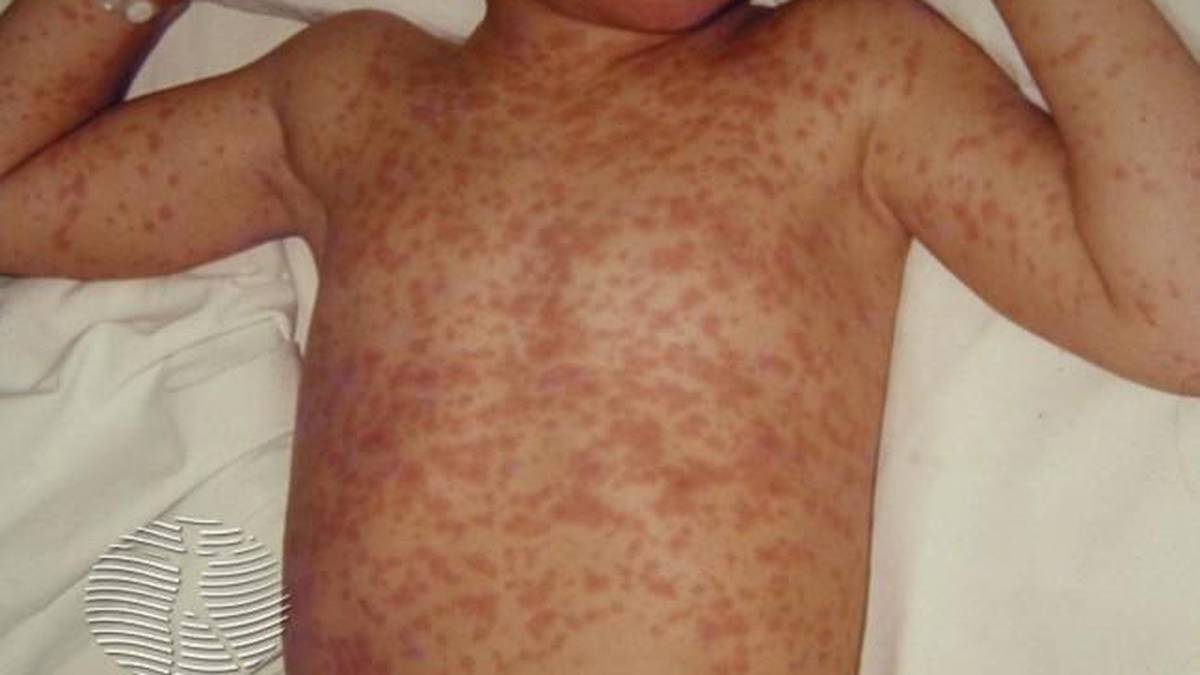 Auckland measles case: What to look out for - NZ Herald