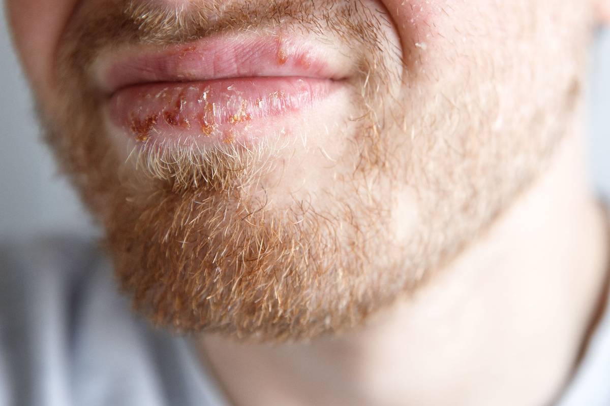 'I gave my father herpes' Reddit post reveals shared razor almost