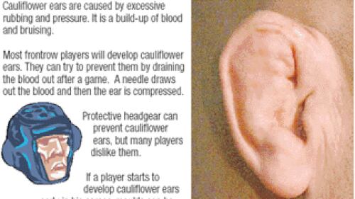 I World Cup Graphic 15 I Cauliflower Ears Nz Herald
