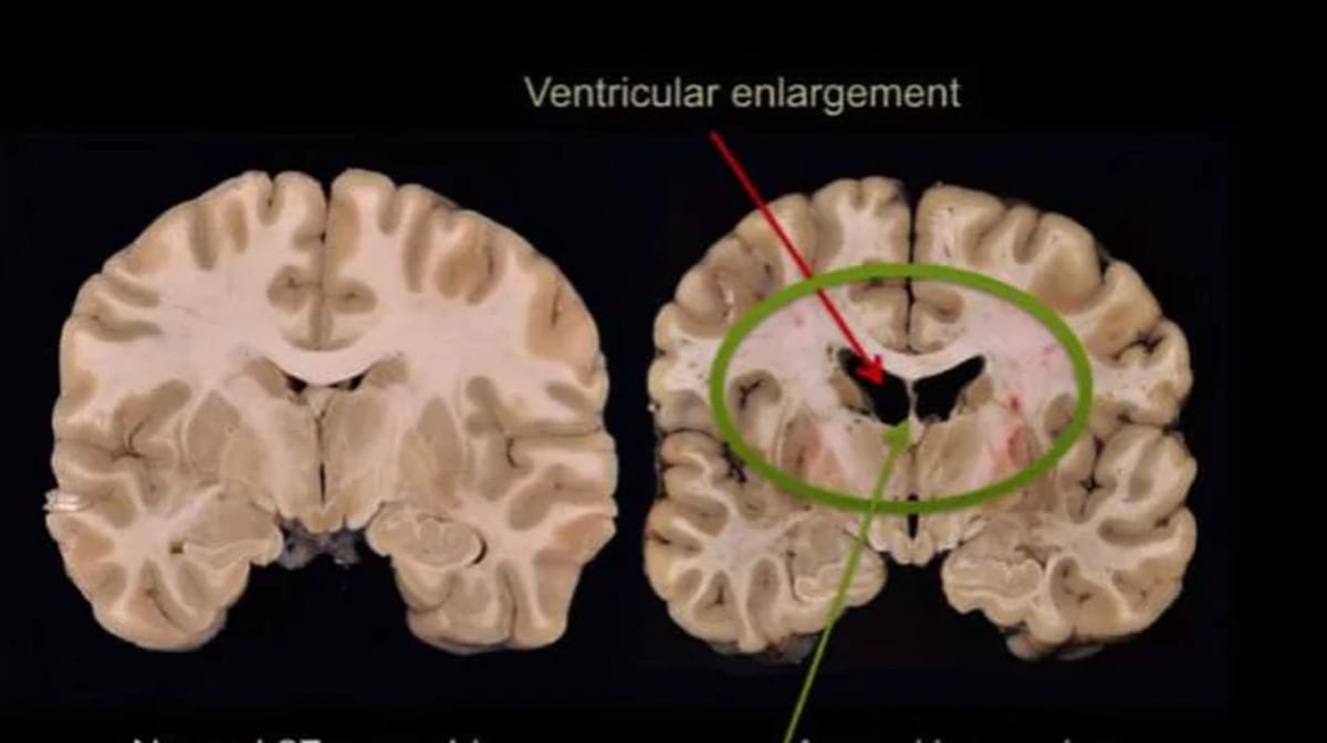 Aaron Hernandez Netflix Documentary Examines How Brain Injury May