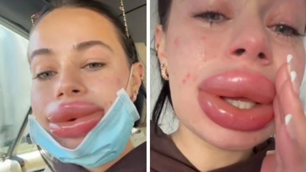 Botched lip filler injection nightmare for influencer Jessica Burko - NZ  Herald