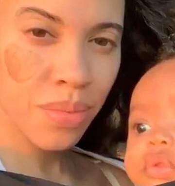 Mum Left With Pubic Hair Growing On Face After Skin Graft Nz Herald