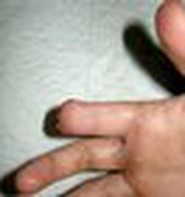 Girl Loses Finger To Tight Band Aid Nz Herald