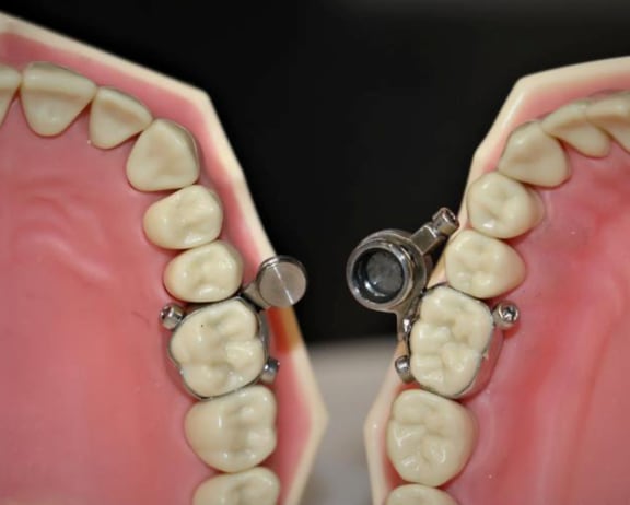 DentalSlim Diet Control: Weight loss device developed in Dunedin locks  mouth almost shut - NZ Herald