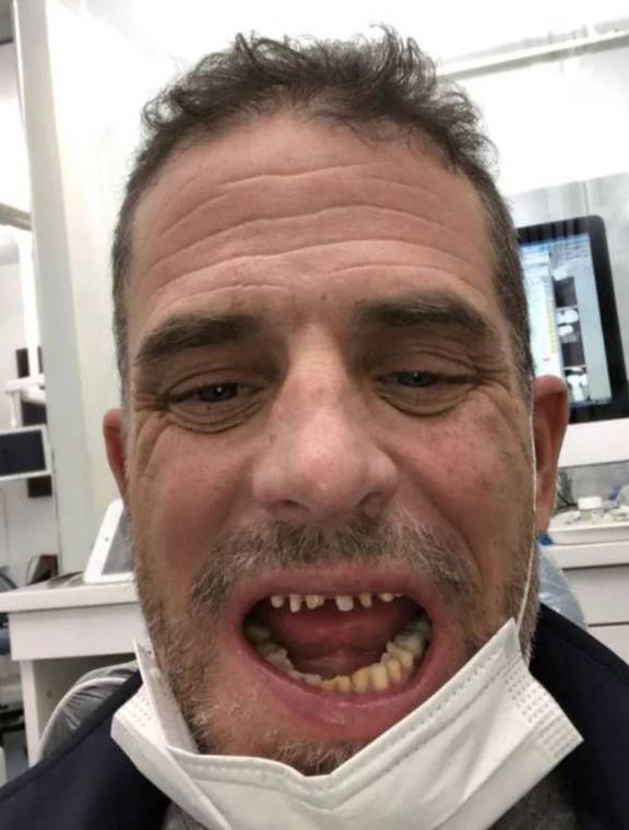 Shocking photos of Hunter Biden's crack addict teeth - NZ Herald