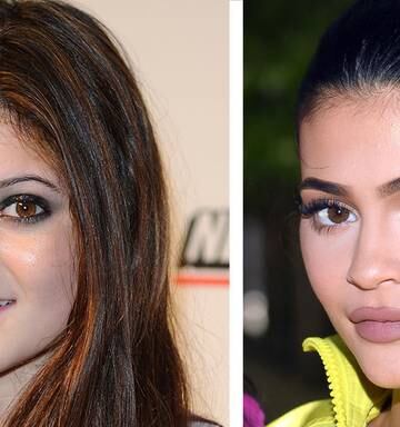 Kylie Jenner Posts Pic After Getting All Her Lip Filler Removed Nz