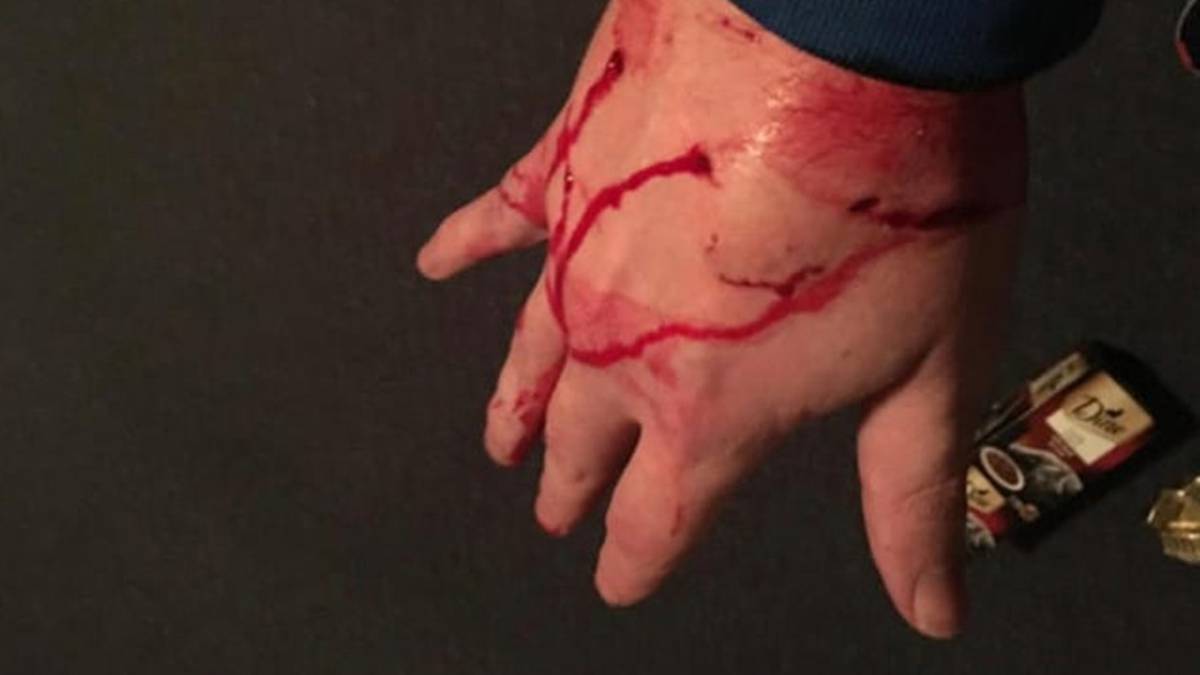 Photo of Der Mensch verliert nach einer Albtrauminfektion fast die Hand an die Zunder-Dattelkatze