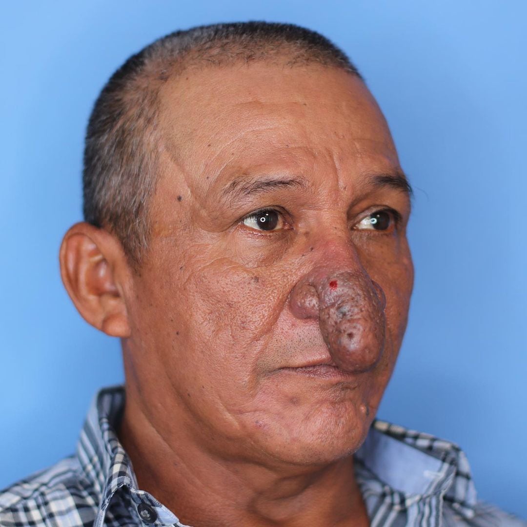 Man with deformed nose gets life-changing surgery - NZ Herald