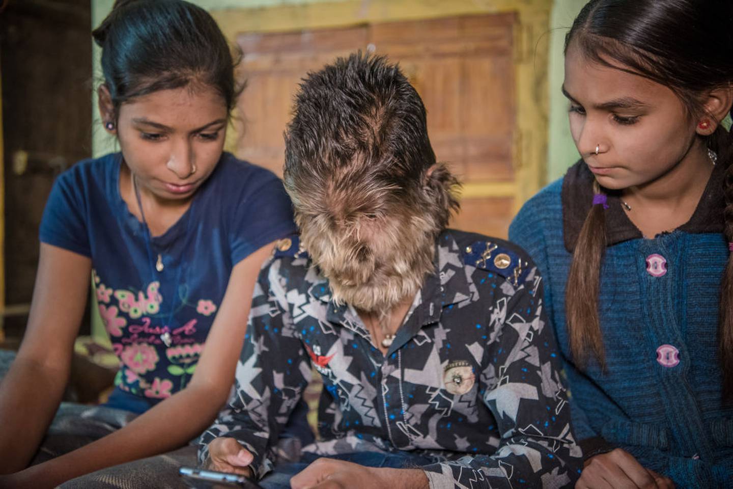 Inkl Sixteen Children Develop Werewolf Syndrome From Taking Contaminated Medicine On Spain S Costa Del Sol The New Zealand Herald