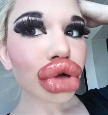 Woman S Extreme Effort To Have World S Biggest Lips Andrea