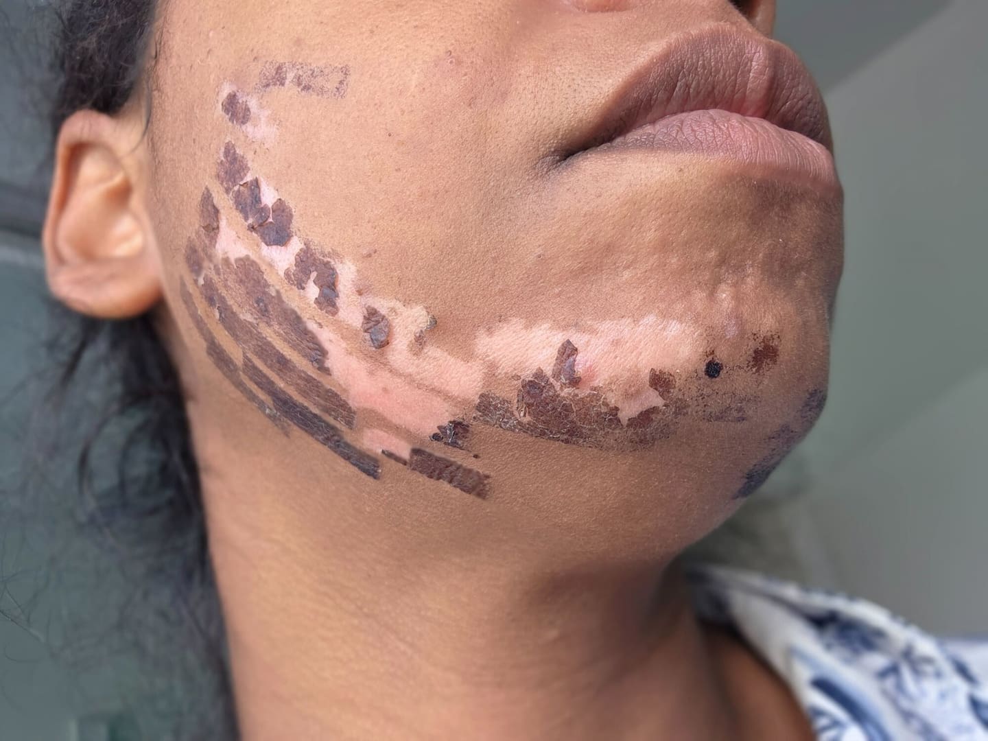 Shirley Agostinha de Oliveira suffered facial burns after receiving a treatment at an Auckland beauty clinic. Photo/ Katie Harris