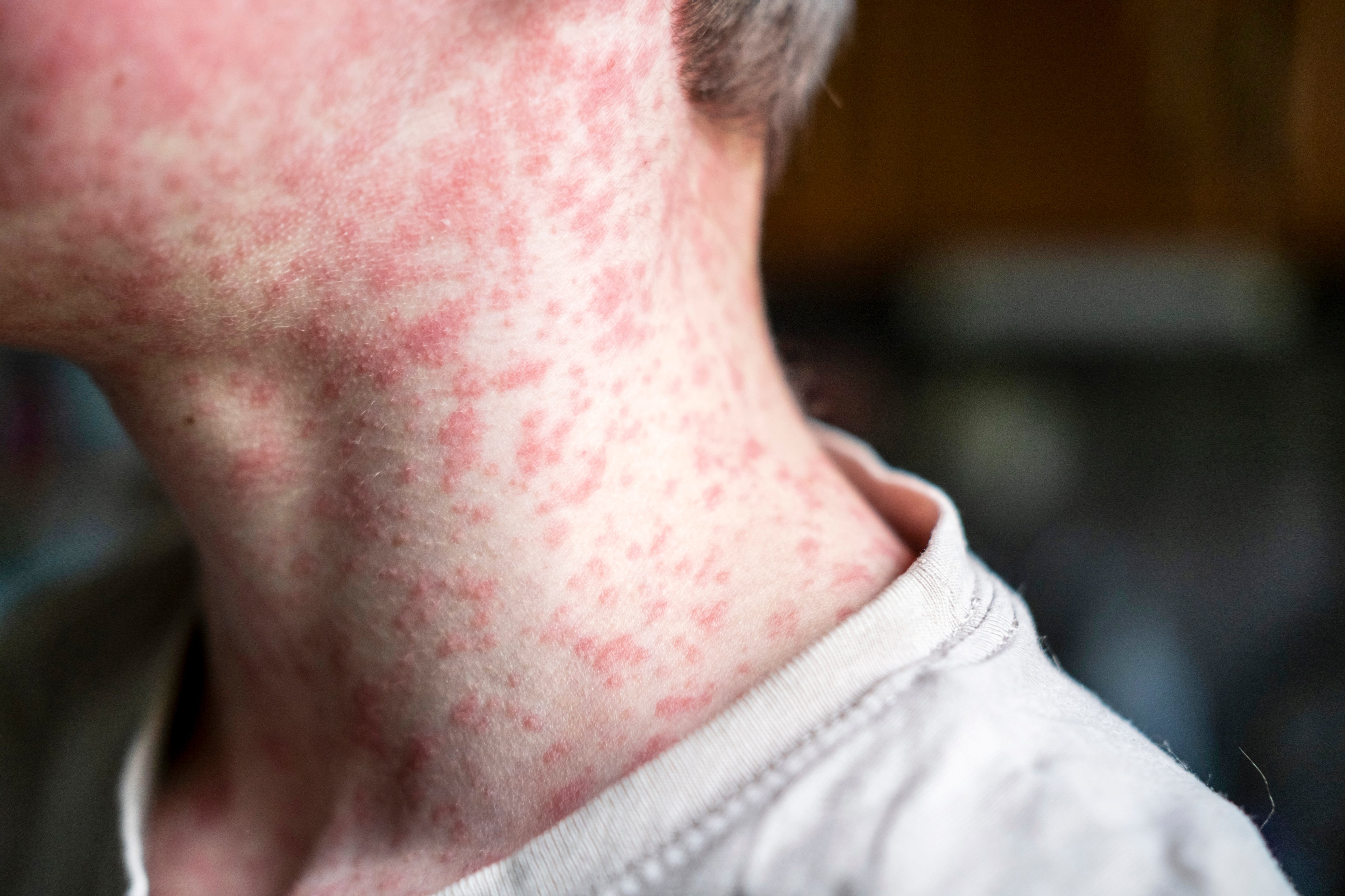 Health NZ warns as measles spreads nationwide