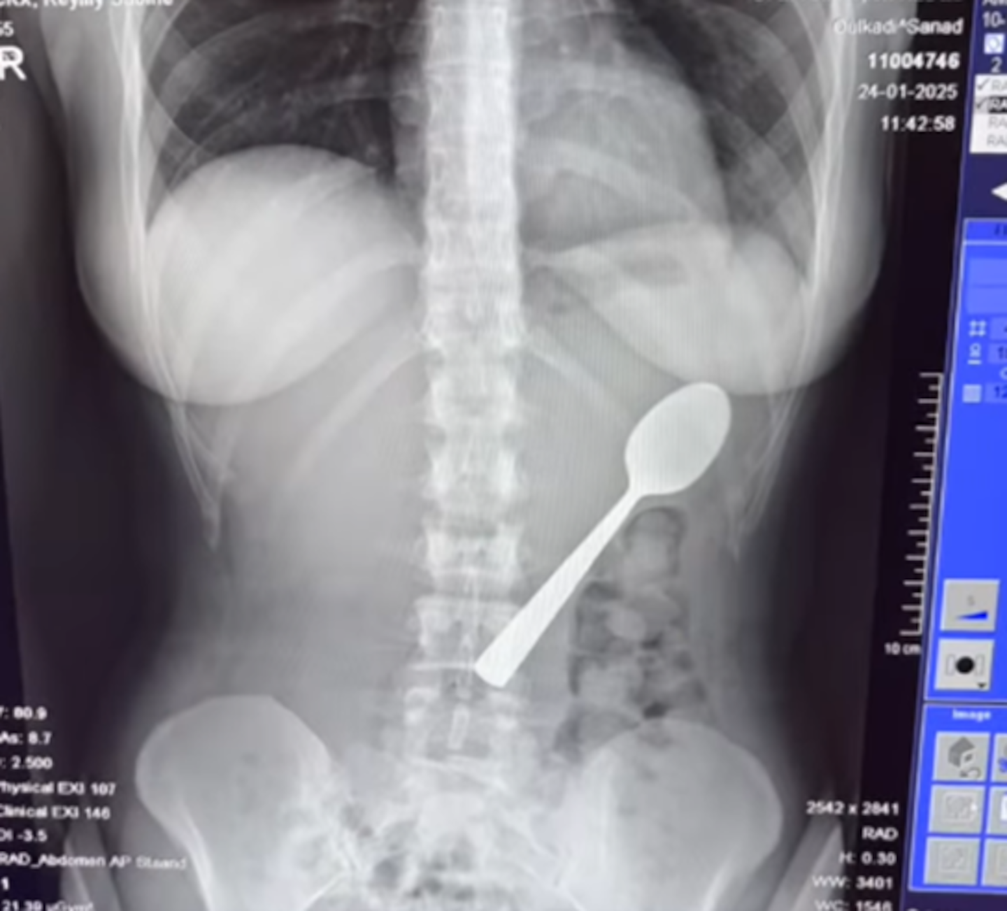 Belgian woman Reymy Amelinckx had to have a spoon surgically removed from her stomach. Photo / @reymyamelinckx