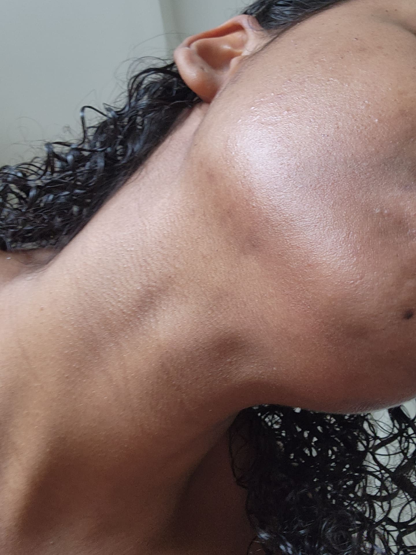 Shirley Agostinha de Oliveira's skin in December before the burns. Photo / Supplied