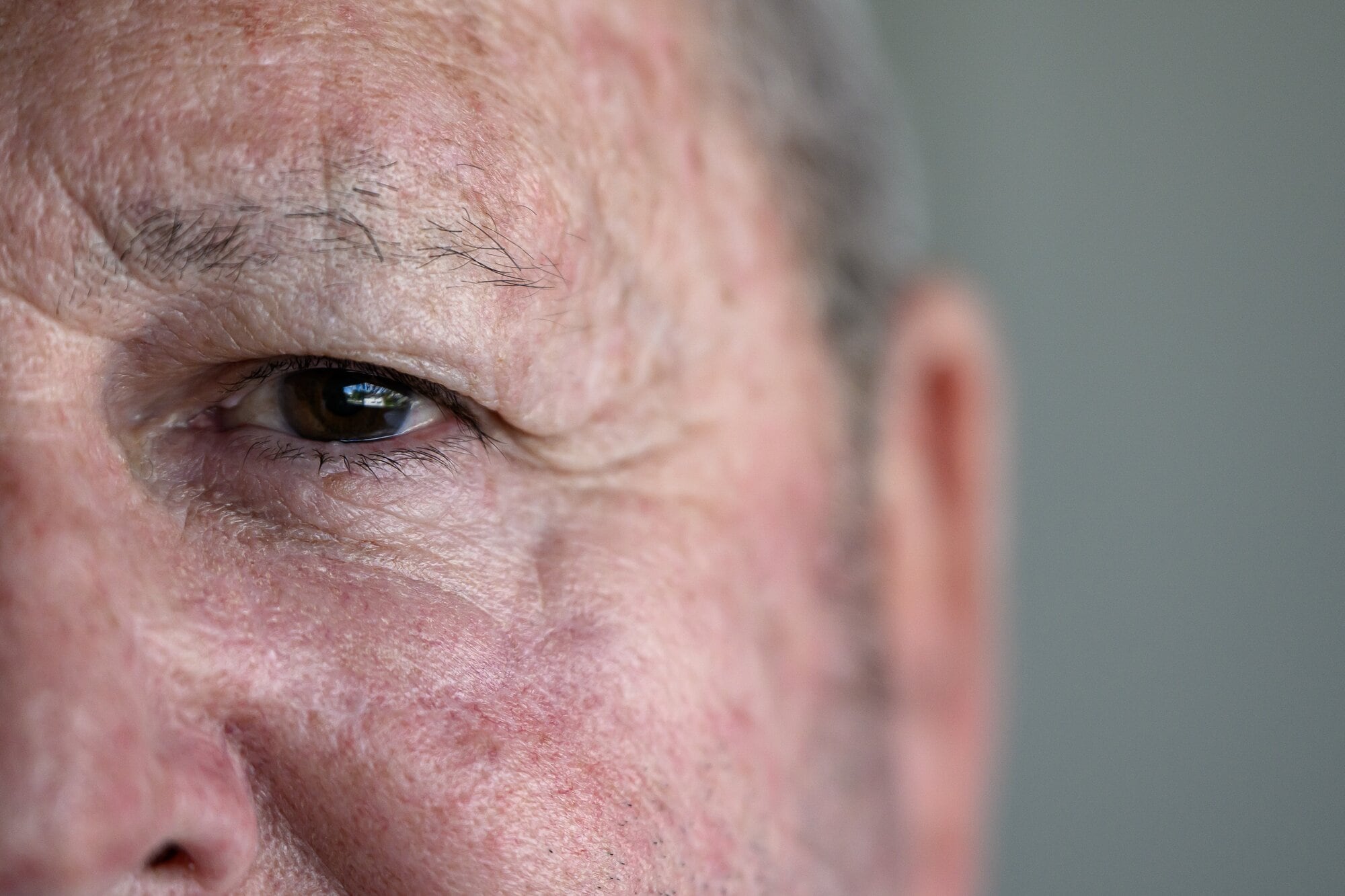 Pāpāmoa man Ray Le Prou had a cancerous mole removed under his left eye. Photo / David Hall