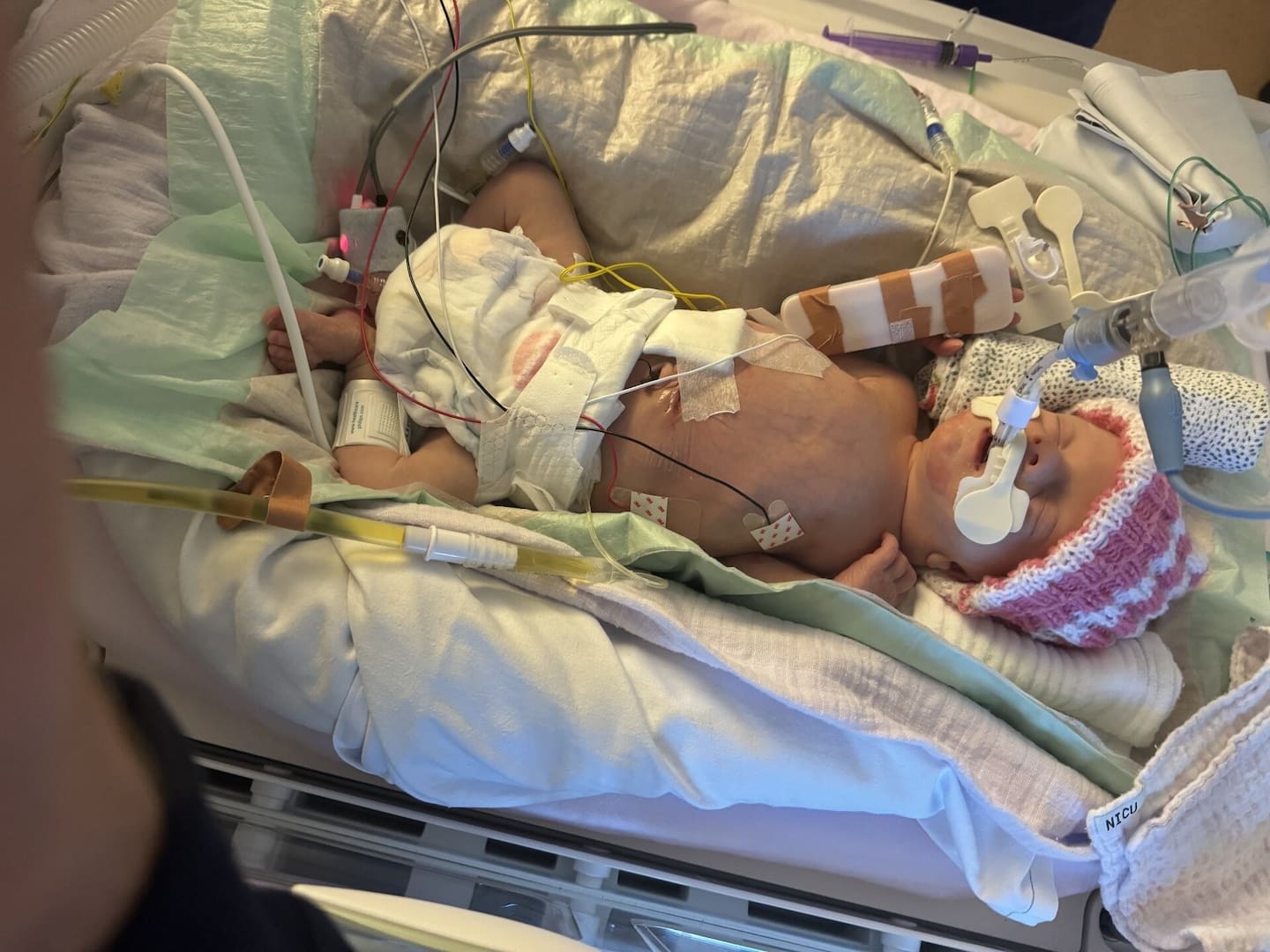Maya Palmer was born prematurely and needed surgery to remove part of her bowel. Photo / Supplied