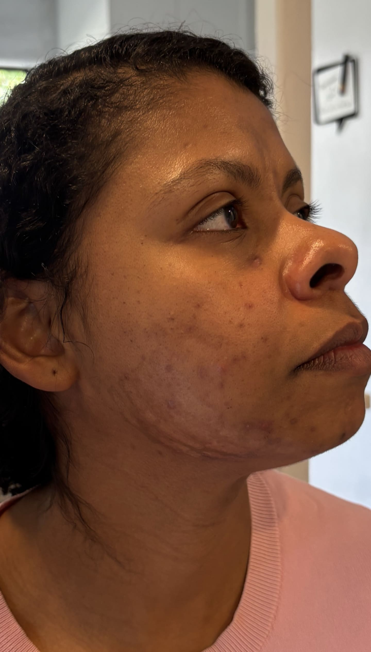 Shirley Agostinha de Oliveira now has scars on her face. Photo / Katie Harris