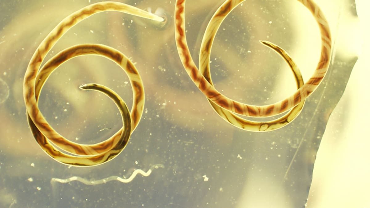 She thought she had jet lag. Doctors found parasitic worms in her brain She thought she had jet lag. Doctors found parasitic worms in her brain