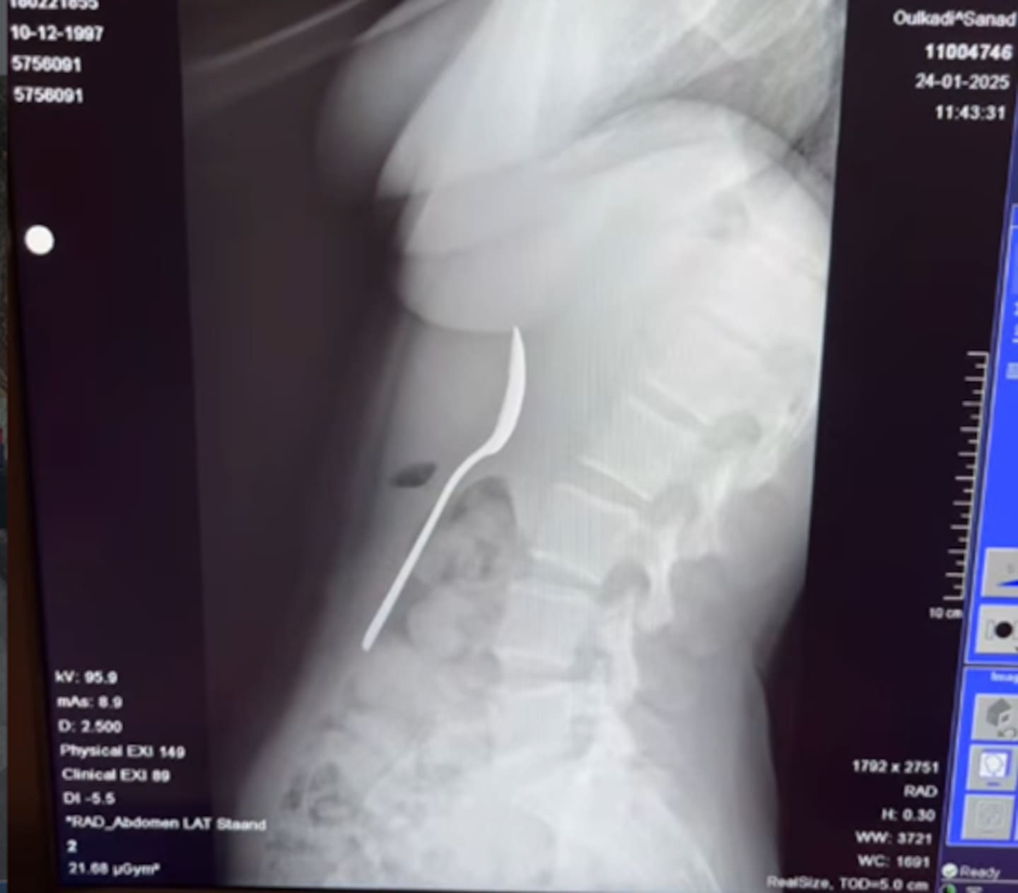 Amelinckx said she was terrified as she felt the spoon move between her ribs. Photo / @reymyamelinckx