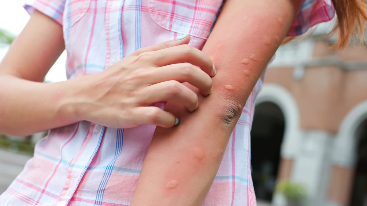 How to stop itchy mosquito bites: Expert tips and tricks How to stop itchy mosquito bites: Expert tips and tricks