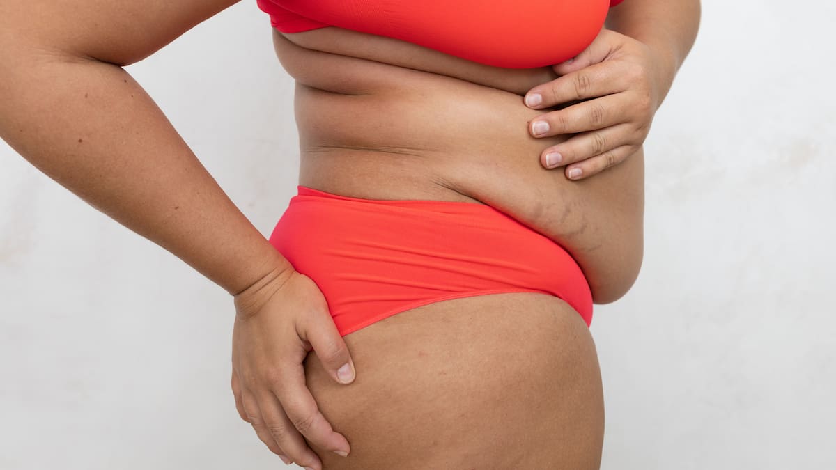 The health risks of an apron belly – and how to get rid of it The health risks of an apron belly – and how to get rid of it