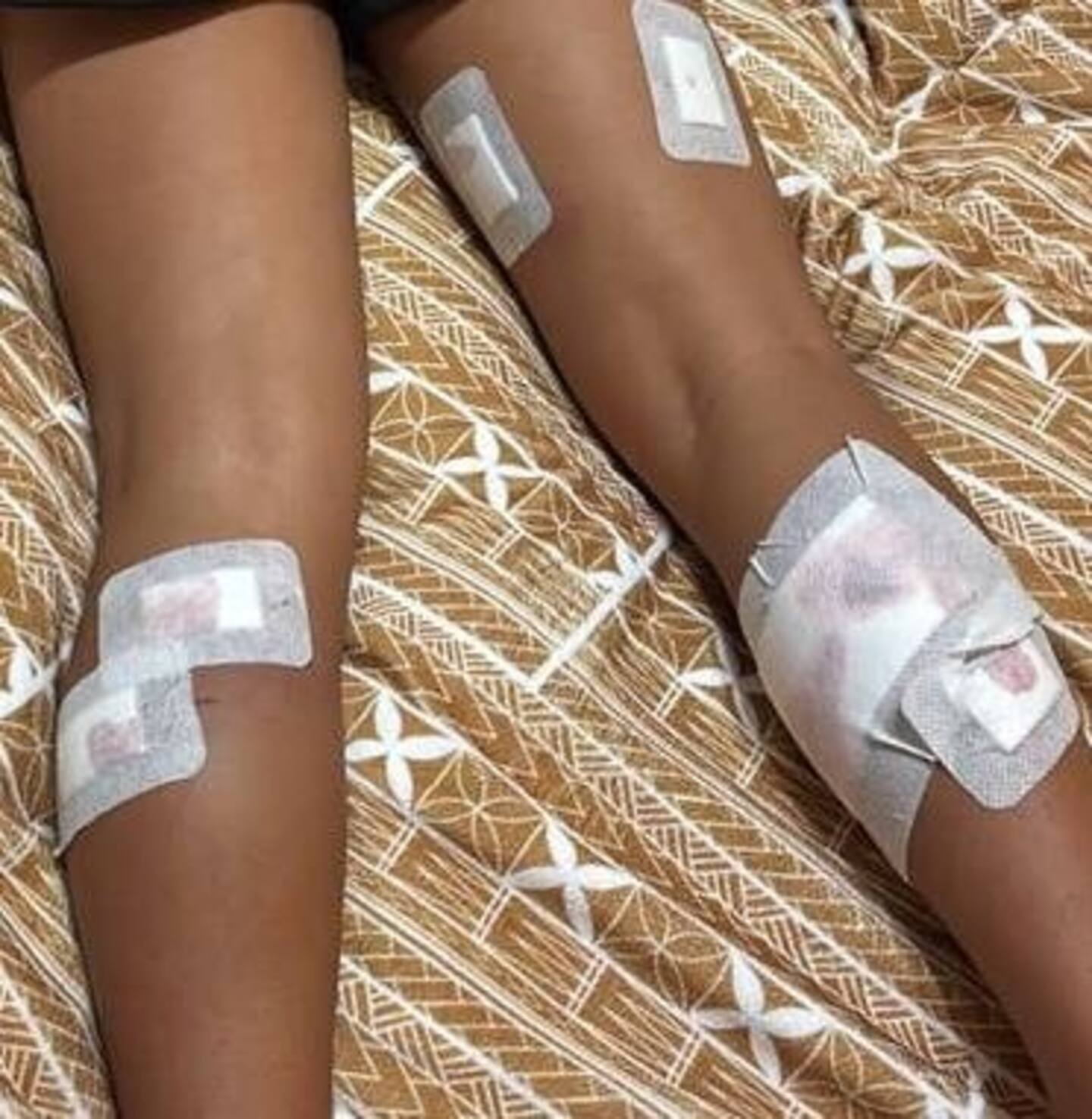 Milan Tufuga pictured after her dog bite wounds were treated on April 22. The 8-year-old was bitten multiple times by an unleashed dog.