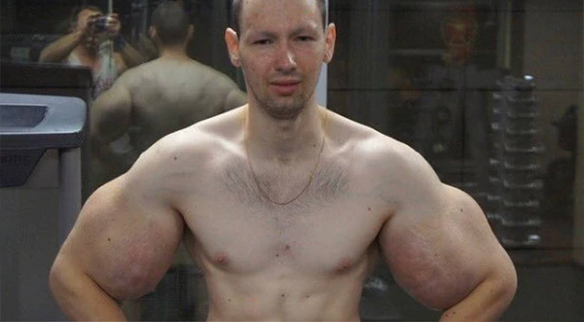 Synthol Addict Kirill Tereshin Has 3 Pounds Of Dead Muscle Honest Mind Here You Read News Sports Entertainment Synthol #biceps #bodybuilding kirill tereshin, a 21 year old russian man the synthol kid, kirill tereshin is also known as the russian popeye due to the size of his arms, achieved using synthol. synthol